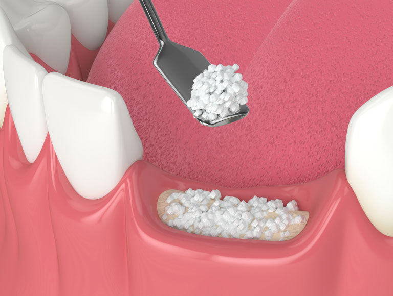 When is Bone Grafting Necessary?