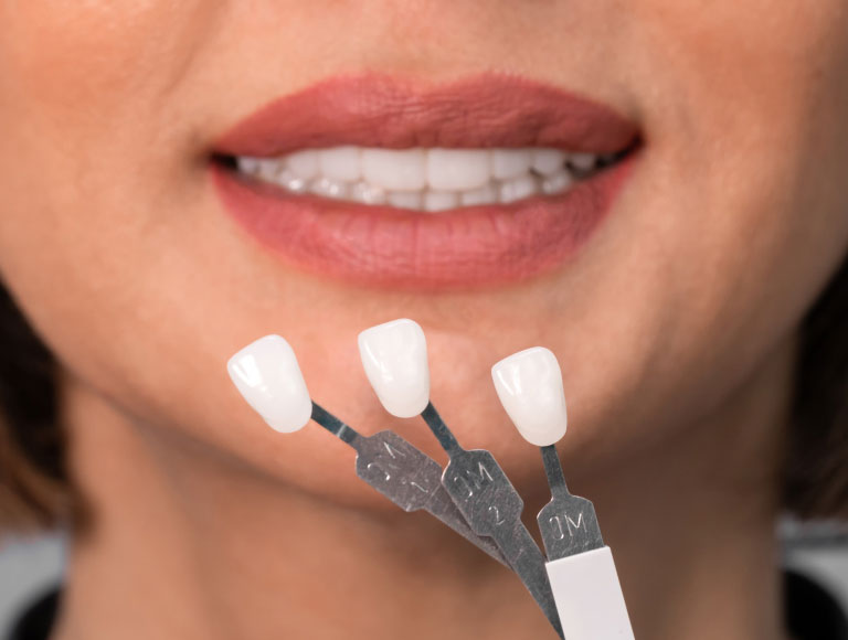 Dental Veneers