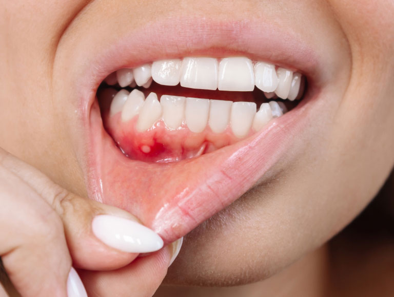 Gum Disease Treatment