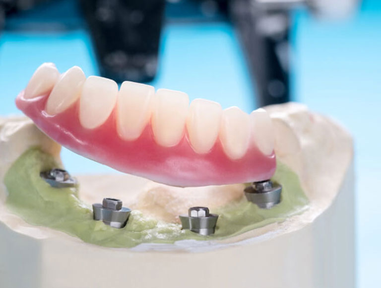 Implant-Supported Dentures